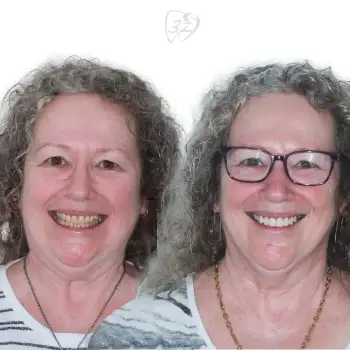 Beyond 32 Dental Before and after case 3 - Karen Daily