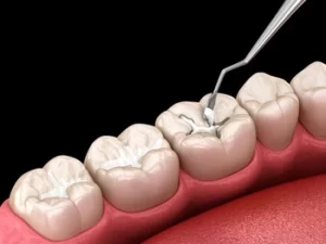 Dos and Don'ts After Tooth Filling procedure