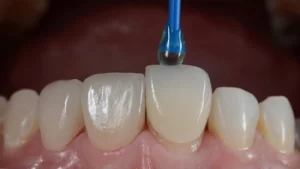 Veneers On Bottom Teeth look like