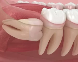 Can Wisdom Teeth Cause Ear and Throat Pain impacted