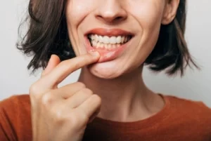Early Stage Brown Tooth Decay gums